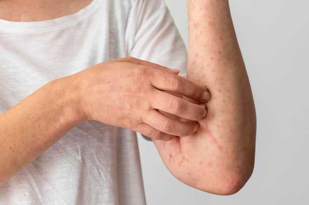 Effects on Psoriasis