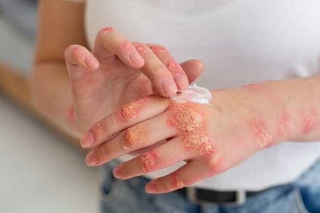What is Metoprolol rash