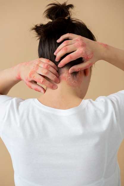 Medical treatments for Metoprolol rash