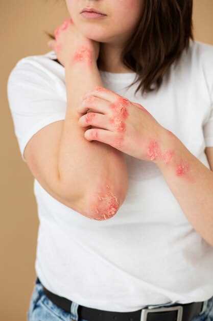 Metoprolol en psoriasis